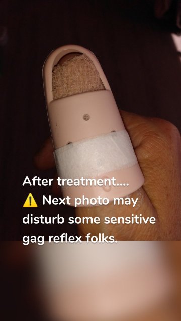 After treatment.... ⚠️ Next photo may disturb some sensitive gag reflex folks.
